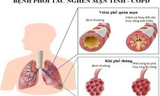 37,5% người trưởng thành ở Việt Nam mắc bệnh phổi tắc nghẽn mạn tính có triệu chứng nghiêm trọng