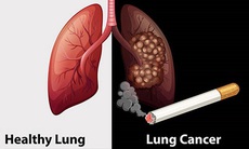 Cảnh báo: Gần 97% số ca ung thư phổi tại Việt Nam có hút thuốc lá