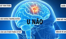 Cảnh báo: U não rất dễ nhầm lẫn với các bệnh lý khác