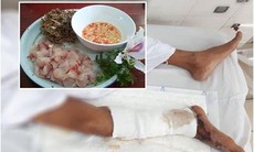 Người đàn ông ăn gỏi cá rô suýt phải cưa chân