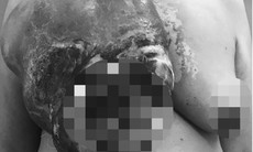 Bỏ điều trị, khối u vú của người phụ nữ ở Nam Định tái phát "khủng", lở loét