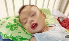 Uống nhầm thuốc tẩy bồn cầu, bé trai 21 tháng bị hậu quả nghiêm trọng về sức khoẻ