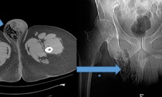 Nam bệnh nhân nước ngoài mắc bệnh lý Fournier gây hoại tử nặng