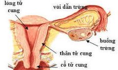 Biến chứng sau phẫu thuật cắt tử cung