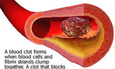 Dùng thuốc tan cục máu đông
