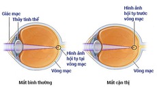 Thực trạng cận thị học đường và cong vẹo cột sốt ngày càng tăng