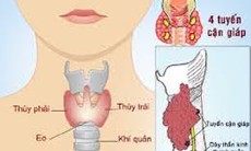 Điều trị ung thư tuyến giáp bằng I-131 cần biết