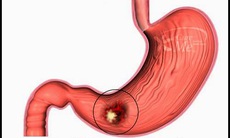 5 đối tượng dễ mắc ung thư dạ dày