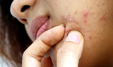 Có nên bôi tỏi lên da để trị mụn trứng cá?