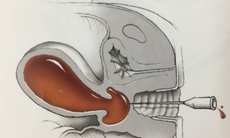 Phẫu thuật thành công cho bé gái bị ứ 0,5 lít máu do dị dạng bộ phận sinh dục hiếm gặp