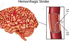 Đột quỵ chảy máu gây tổn thương nặng nề cho não bộ
