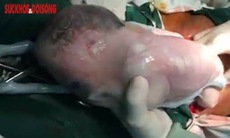 Cực kỳ hy hữu tại Việt Nam: Khoảnh khắc 3 em bé còn nguyên bọc ối chui ra từ bụng mẹ