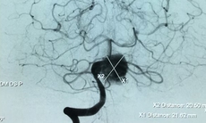 Lần đầu tiên can thiệp túi phình mạch máu não khổng lồ không cần gây mê