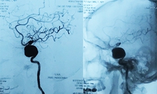 Chữa túi phình mạch máu não khổng lồ bằng kỹ thuật bắc cầu