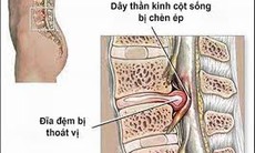 Thoát vị đĩa đệm cột sống thắt lưng: Cần chữa trị kịp thời trước khi bệnh gây tàn phế