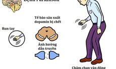 Cách nhận biết sớm dấu hiệu Parkinson