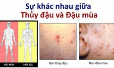 FDA phê duyệt thuốc đầu tiên trị bệnh đậu mùa