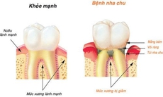 Bệnh nướu răng làm tăng nguy cơ sa sút trí tuệ