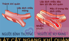 Thuốc trị bệnh xơ nang cho bệnh nhân từ 6 tuổi trở lên