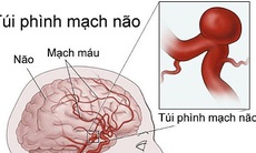 Hút thuốc làm tăng nguy cơ phình động mạch ở phụ nữ