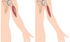 Thuốc mới trị bệnh loạn dưỡng cơ Duchenne do đột biến gen