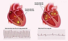 Bỏ hút thuốc giúp giảm nguy cơ tử vong do rung tâm nhĩ