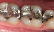 Cảnh báo rủi ro khi dùng chất trám răng chứa thủy ngân ở một số người