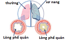 Thuốc cải thiện chức năng phổi ở bệnh nhân bị xơ nang