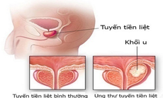 Liệu pháp hormone trị ung thư tuyến tiền liệt có thể làm tăng nguy cơ tim mạch