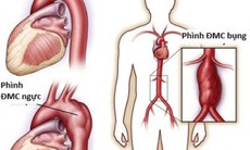 Fluoroquinolones có liên quan đến tăng nguy cơ phình động mạch chủ