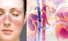 Thuốc mới trị viêm thận lupus: Nhiều bất lợi cần chú ý khi sử dụng