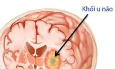 Độc tố trong thịt chưa nấu chín có liên quan đến u não hiếm gặp