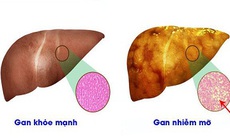 Uống nhiều rượu có thể gây bệnh gan nhiễm mỡ