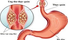 Thuốc tăng cường miễn dịch giúp kéo cuộc sống ở người ung thư thực quản