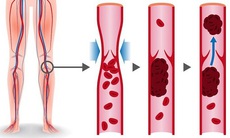 “Chuột rút” có thể cảnh báo cục máu đông nguy hiểm   