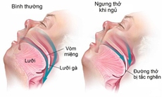 Điều trị ngưng thở khi ngủ, giúp giảm nguy cơ mắc Alzheimer