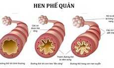 Thuốc mới hứa hẹn chống lại bệnh hen suyễn nặng không kiểm soát