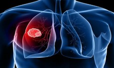 Thuốc mới trị ung thư phổi liên quan đến một số gen nhất định