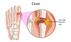 Kết hợp 2 loại thuốc: Giải pháp mới điều trị cho người mắc bệnh gút kháng trị