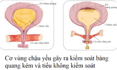 Tiểu không kiểm soát có thể ảnh hưởng đến sức khỏe tâm thần của phụ nữ