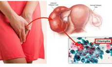 Câu hỏi thường gặp về Chlamydia