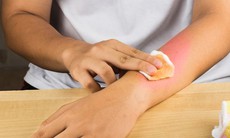 Da nhân tạo- hi vọng mới cho bệnh nhân bỏng