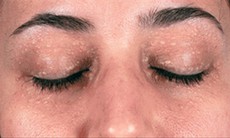 Các biện pháp chữa mụn thịt
