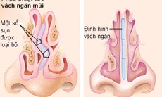 Làm sao phát hiện vẹo vách ngăn mũi?