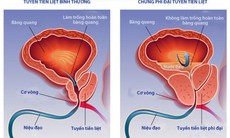 Thuốc điều trị phì đại lành tính tuyến tiền liệt có liên quan với suy tim