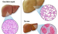 Người gầy, trẻ nhỏ cũng có thể mắc gan nhiễm mỡ