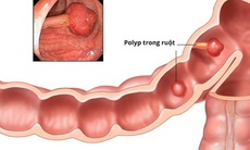 Cảnh báo: Phần lớn ung thư đường tiêu hóa phát triển từ polyp