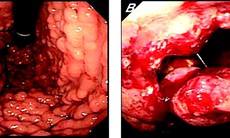 Chủ quan nghĩ đau bụng do viêm loét, đi khám thành ung thư dạ dày