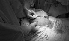 Hai giờ đồng hồ bác sĩ "đánh vật" với khối u xơ tử cung to bằng thai 9 tháng