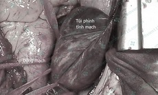 Mệt, khó thở, đau tức ngực....không ngờ mắc bệnh hiếm gặp